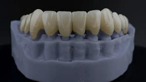 reabilitare mandibula scanare intraorala