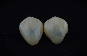 fatete dentare premium pe model de laborator digital