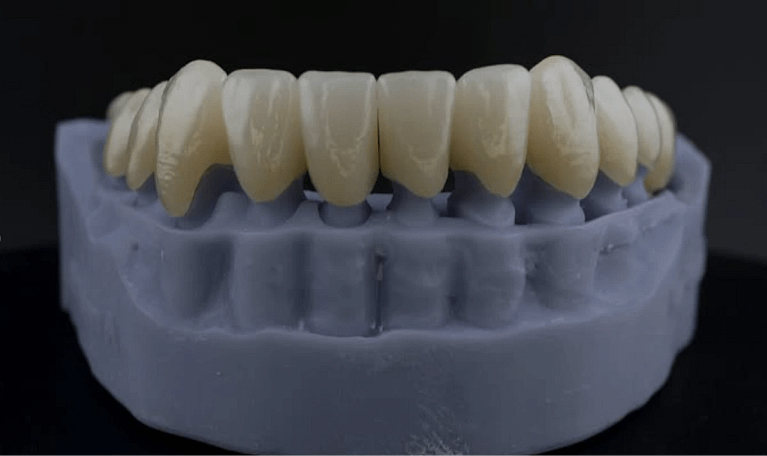 reabilitare mandibula scanare intraorala